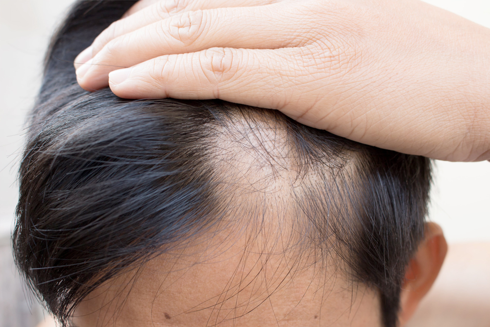 Calvície e queda de cabelos: cortes estratégicos valorizam os fios